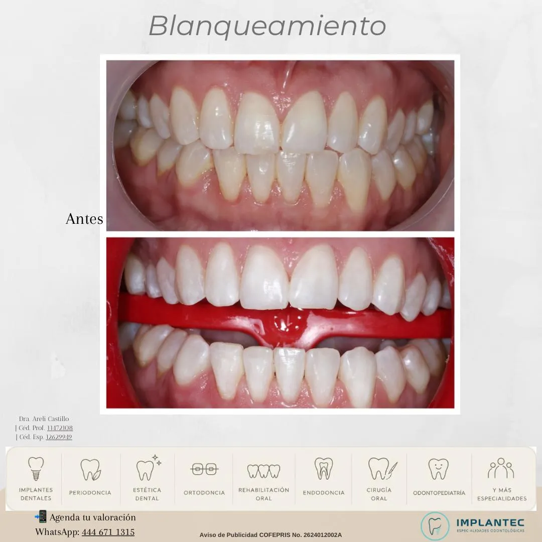 Blanqueamiento dental