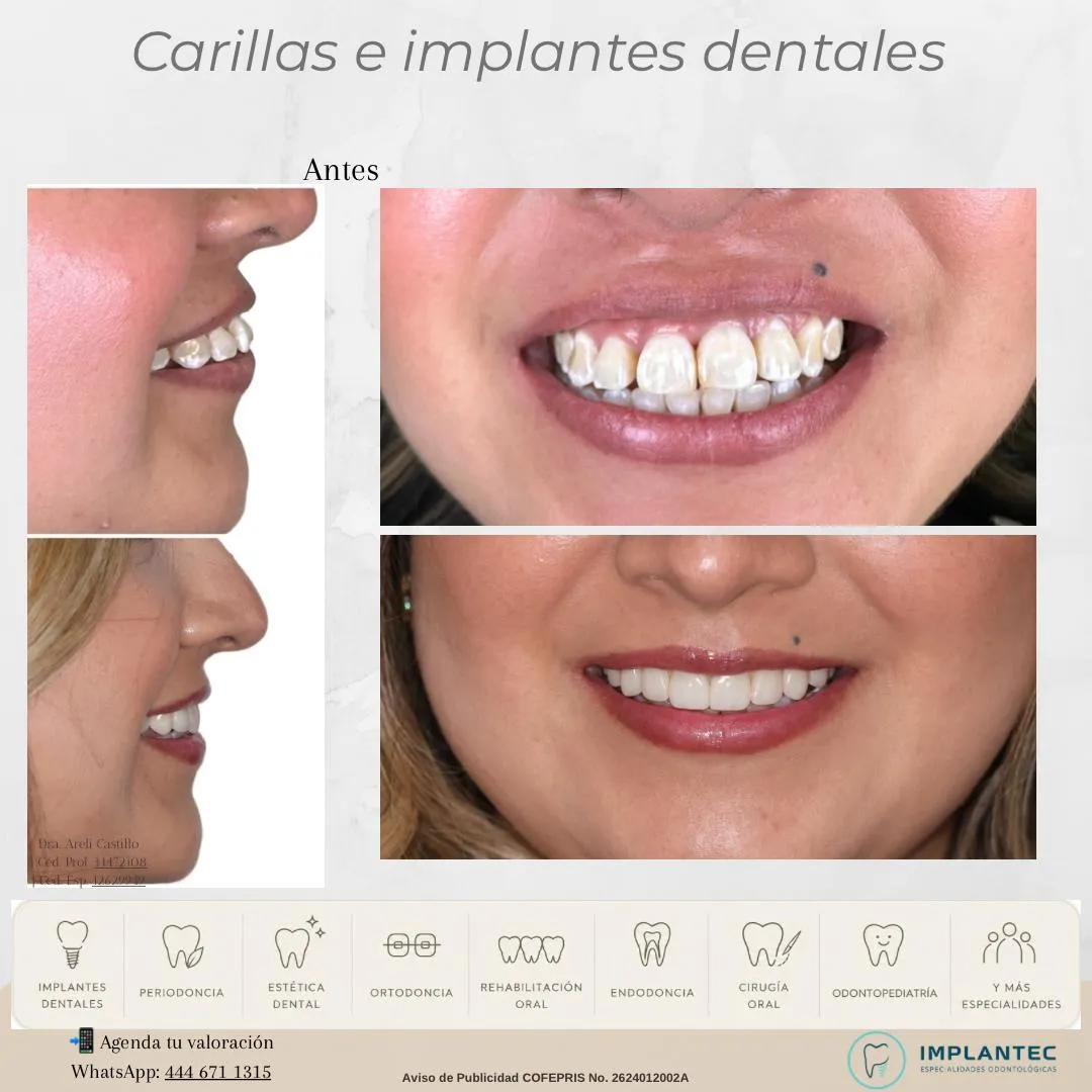 Carillas e implantes dentales
