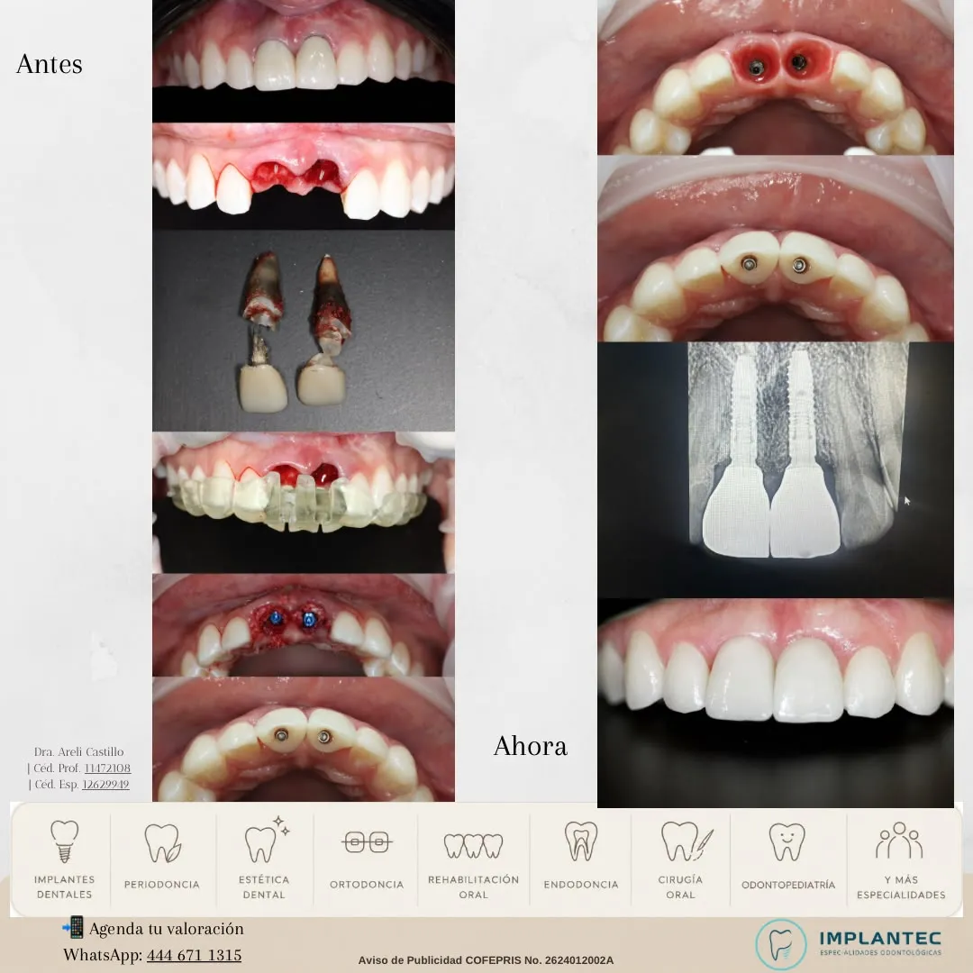 Implantes en la zona anterior