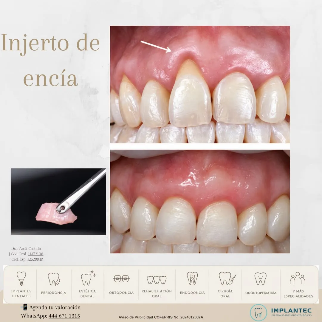 Injerto de encía