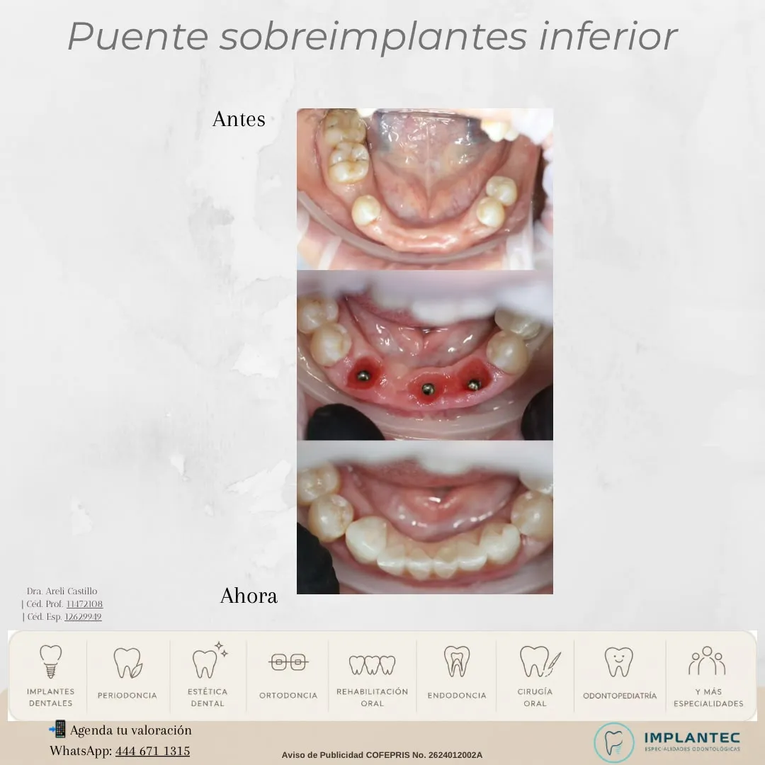 Puente sobre implantes inferior
