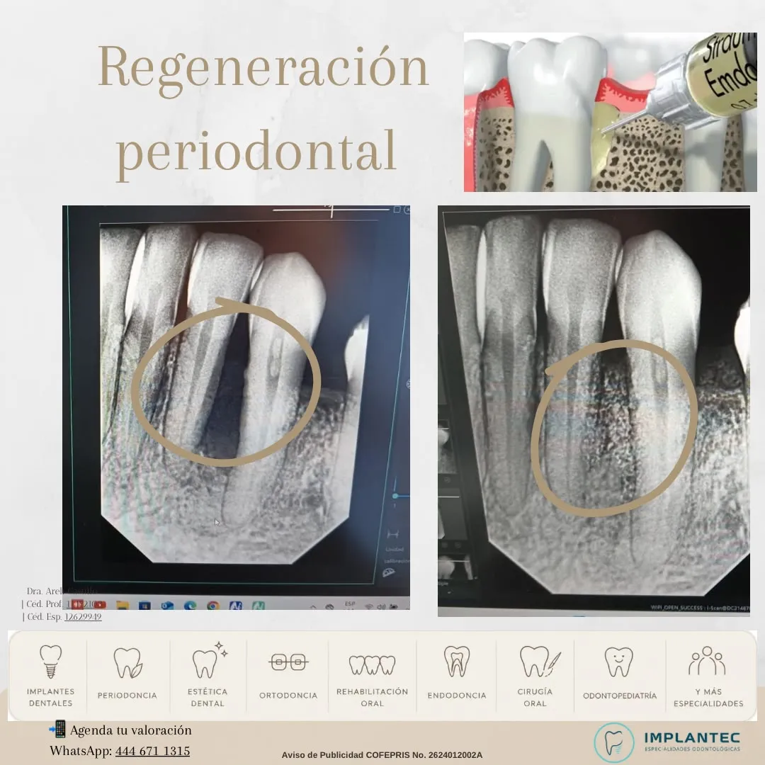 Regeneración periodontal